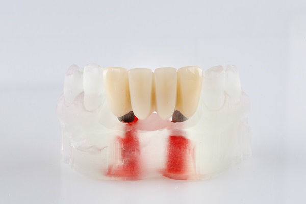 Tips To Extend The Longevity Of Implant Supported Dentures